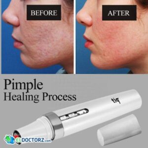 Tiq 24H Pimple Healing Process | Acnecare | جهاز تنظيف وتقشير البشرة